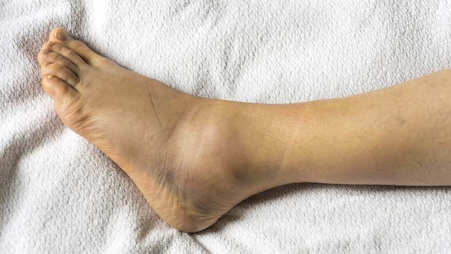 GRADE 3 ANKLE SPRAIN