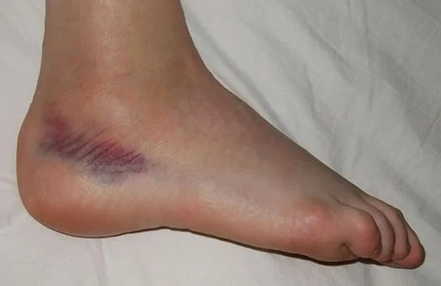 severe sprained ankle bruising