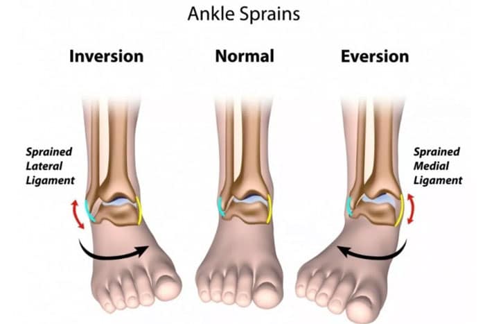 ankle sprain types