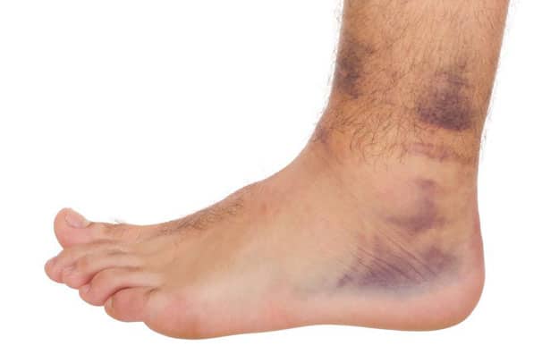 sprained ankle