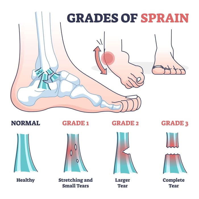 grades sprained ankle
