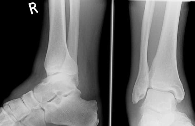 ankle xray