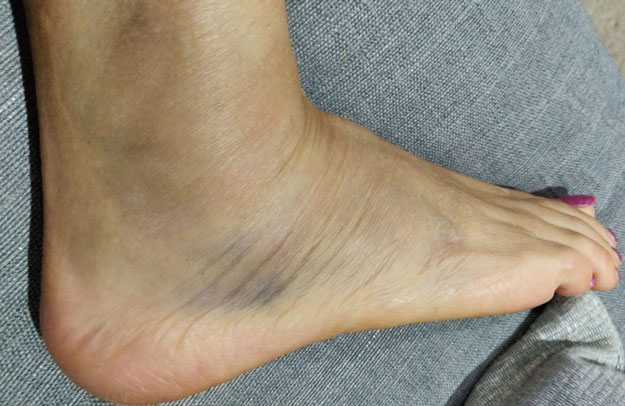 Grade 2 ankle sprain bruising and swelling