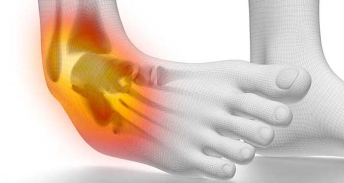 GRADE 3 ANKLE SPRAIN TREATMENT