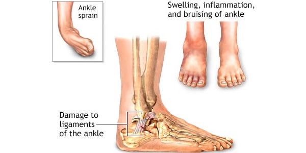 sprained ankle