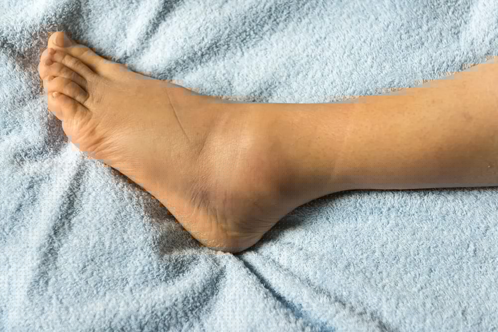ankle sprain vs break illustration