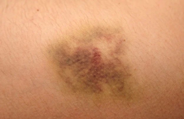 bruising after ankle sprain