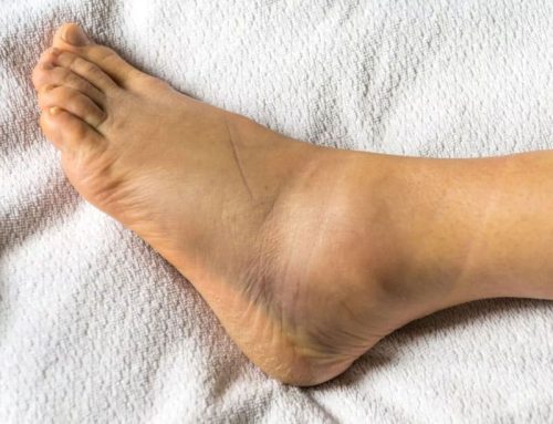 The Best Rehab for a Grade 2 Ankle Sprain