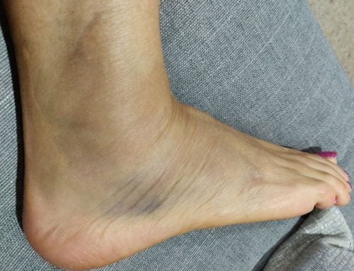 The Best Rehab for a Grade 1 Ankle Sprain